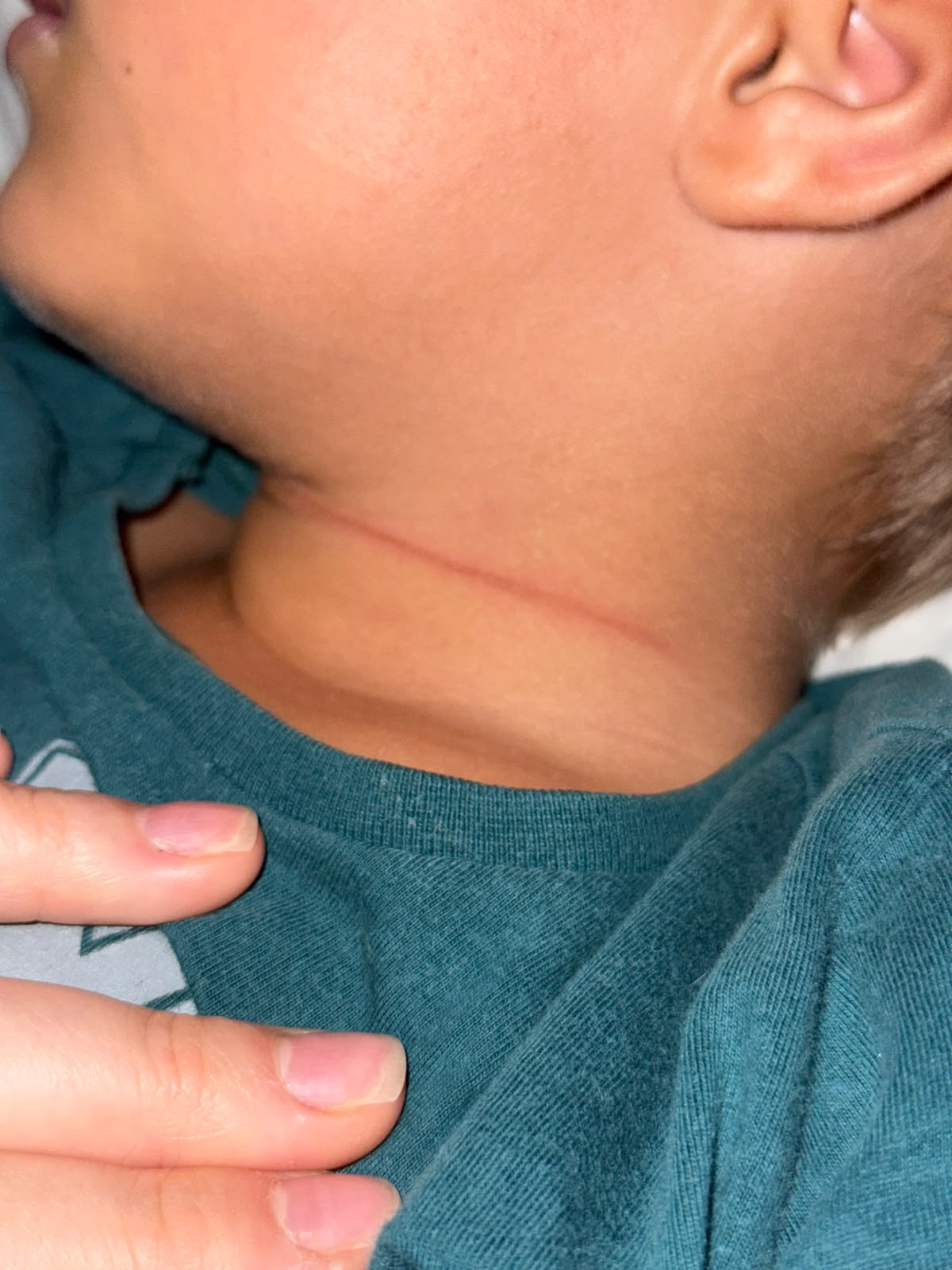 Em Parnaíba, menino de 4 anos tem pescoço cortado ao ser atingido por linha com cerol